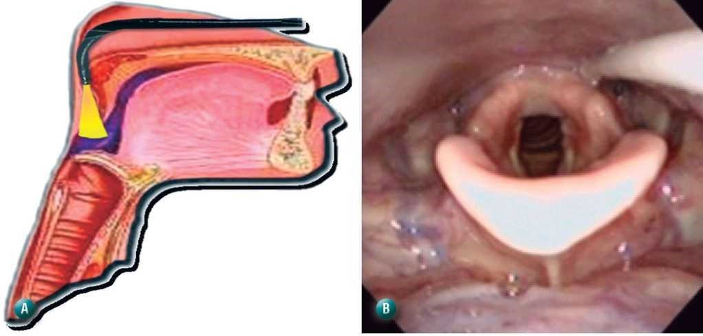 videoendoscopia nasal videolaringoscopia