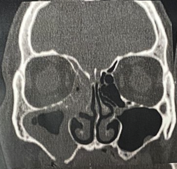 cirurgia da sinusite (as sinusectomias)